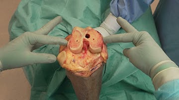 Total knee arthroplasty (mechanical alignment)
