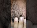 #ingrownhairremovel #beard #relax #asmr #odlysatisfying