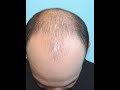 اللقاء الخامس و العشرون ثانيا دلائل مزاج الدماغ الصفراوي الحار اليابس