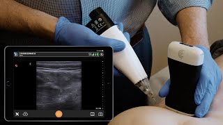 Cluneal Nerve Block