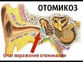 Отомикоз (грибок в ушах)