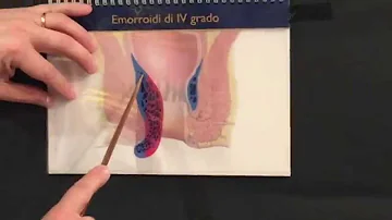 Come si fa a capire se sono emorroidi?