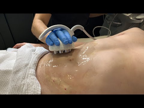 HOW TO KEEP SKIN TIGHT AFTER LIPOSUCTION | Venus Legacy | Dr. Jason Emer