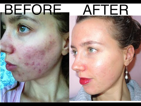 face slimming mask before and after 8 day