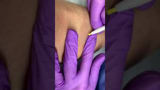 Электроэпиляция Povolosku Apilus