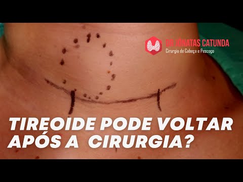 Tireóide pode voltar