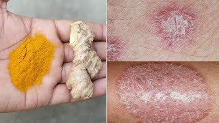 4 दिन में दाद खाज खुजली की छुटी कर देगा ये जादुई नुस्खा | ringworm treatment | daad khaj khujli