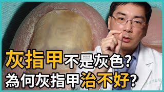 灰指甲不是灰色的嗎還有其他顏色嗎為何灰指甲一直治不好讓皮膚科林政賢醫師一一點破治療灰指甲的NG行為吧