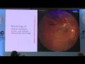 AIOC2024  IC13 Topic  Dr Soumyava Basu Retinal vasculitis  step wise investigations and management