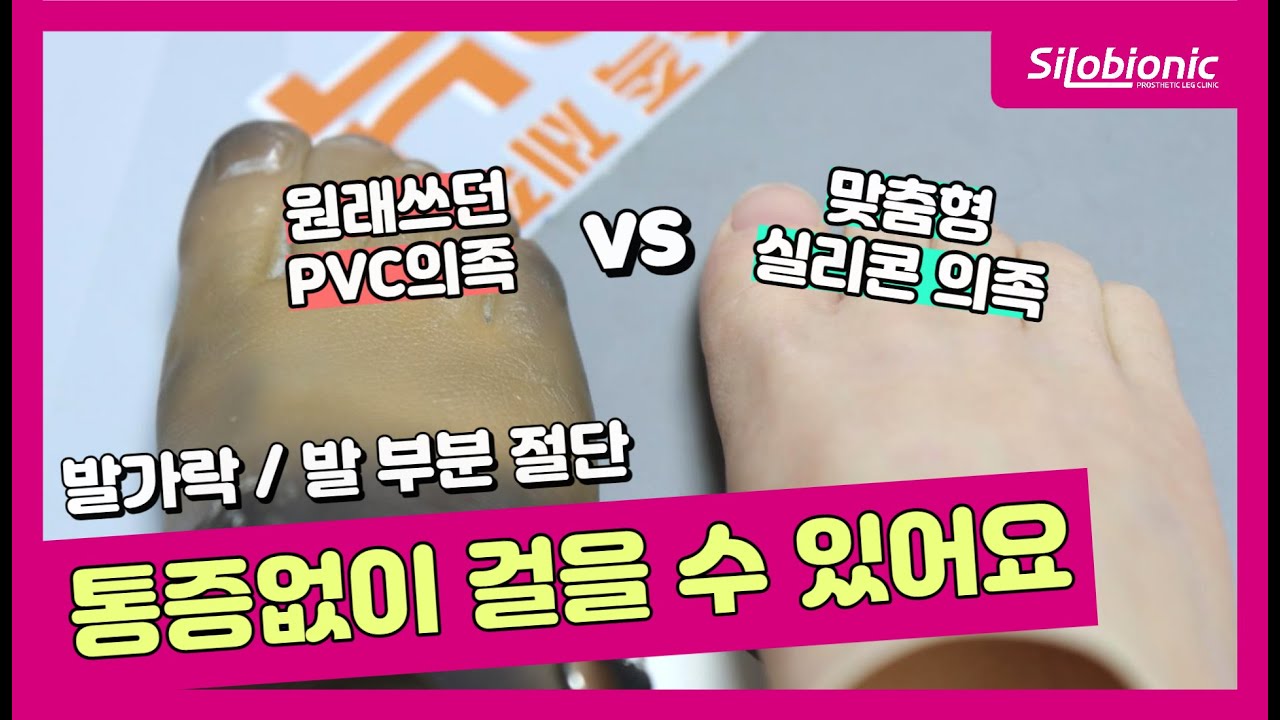 발가락 발 부분 절단, 찌르는 듯한 통증을 실리콘 의족으로 해결했어요!