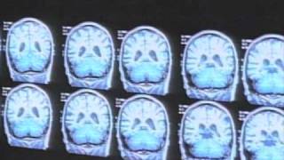 Brain Scans Find Consciousness in Some 'Vegetative' Patients