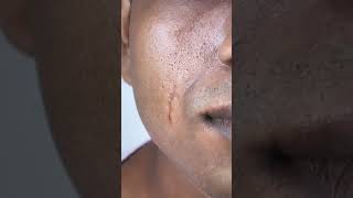 Cosmetic scar revision - results after 9 months