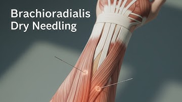💪 Brachioradialis Dry Needling | Instant Relief for Forearm Pain & Tightness!