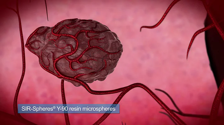 Y90 Treatment for Liver Cancer