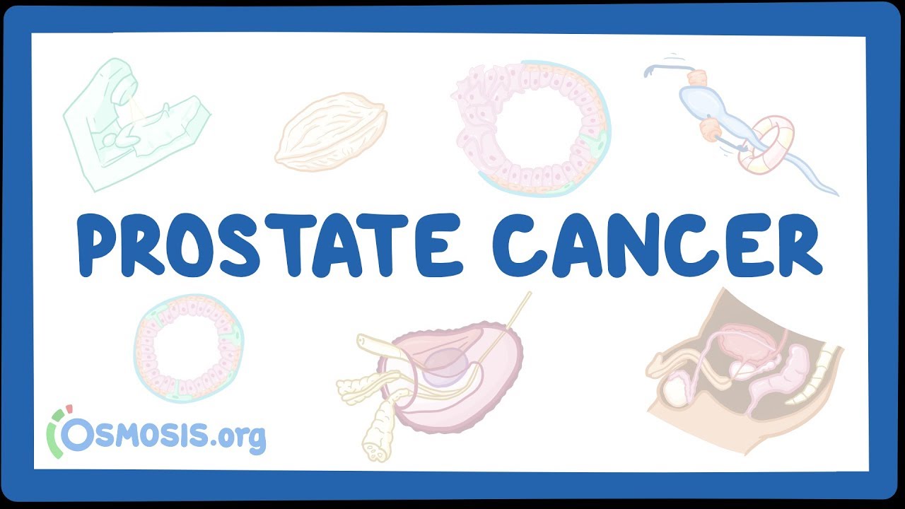 prostate cancer ppt 2018