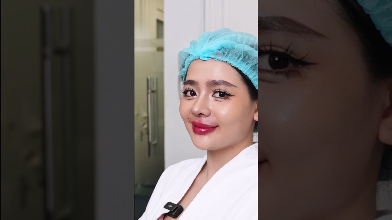 #Lâm_Nam_Phương thay đổi sau 14 ngày cùng dáng mũi Babie Line #phongkhamncb #nangmui #babieline