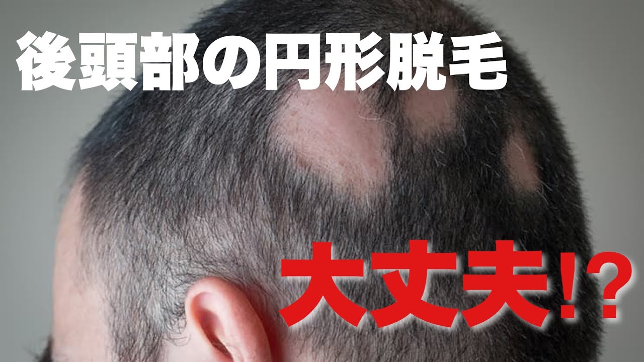 後頭部の円形脱毛 ほっておいてもダイジョウブ Youtube
