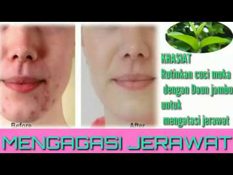 Cara mengatasi jerawat dengan alami - YouTube