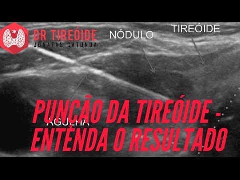 Vídeo: Testes De Função Da Tireóide: Procedimento, Efeitos Colaterais E Resultados