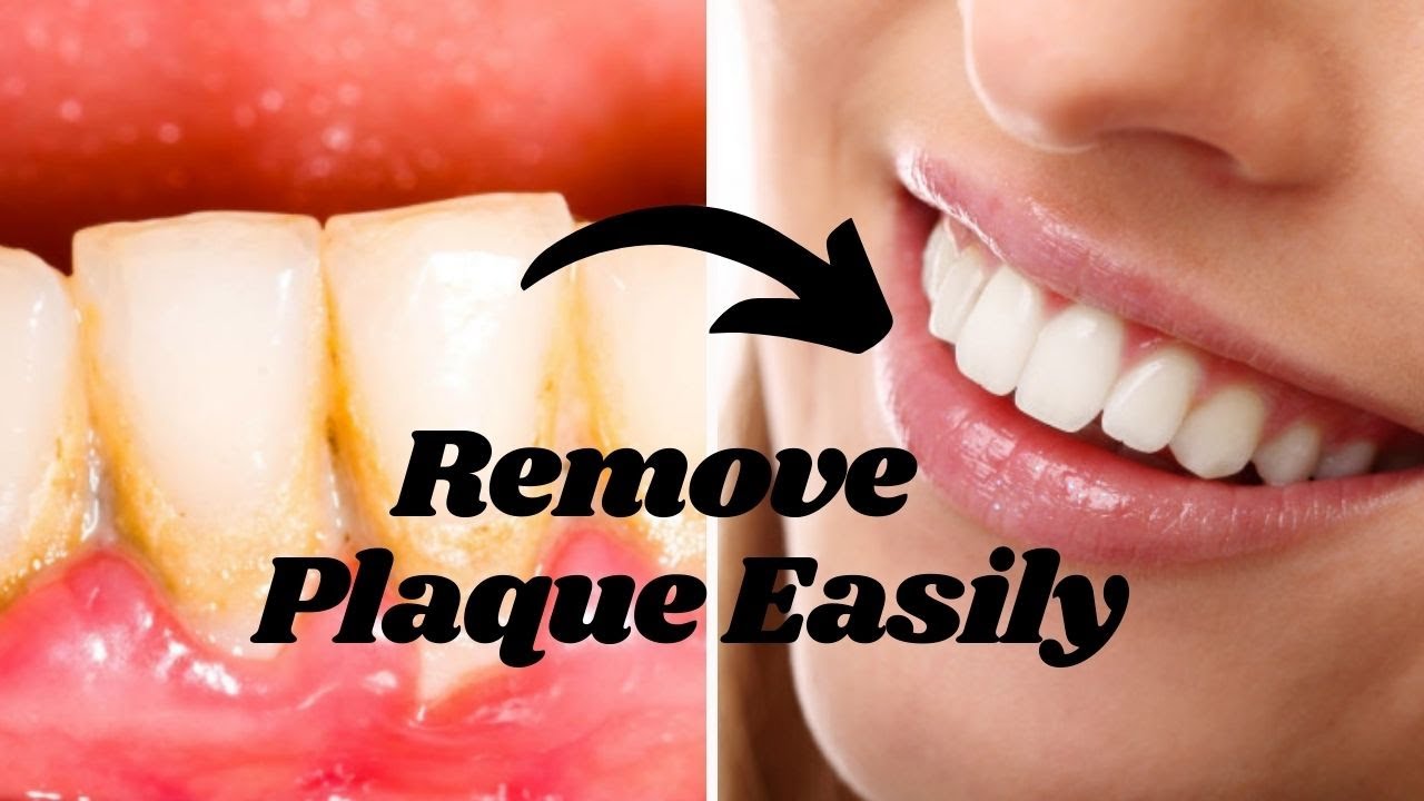 How to remove plaque from teeth How to remove plaque from teeth at