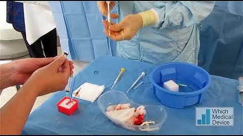 Embolisation of a renal AML using Onyx