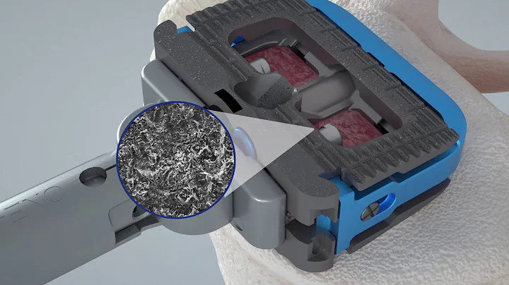 MAGNIFY®-S Stand-Alone Spacer