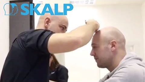 See how SMP can change your life- Affordable hair loss solution