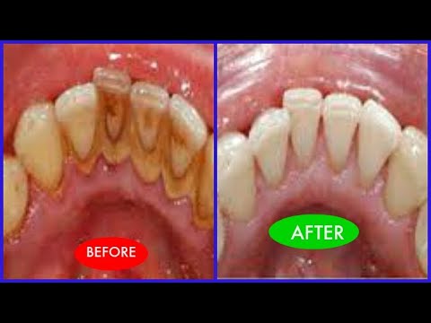 GET RID OF PLAQUE ON TEETH FAST, GET WHITE BRIGHT TEETH FAST - YouTube