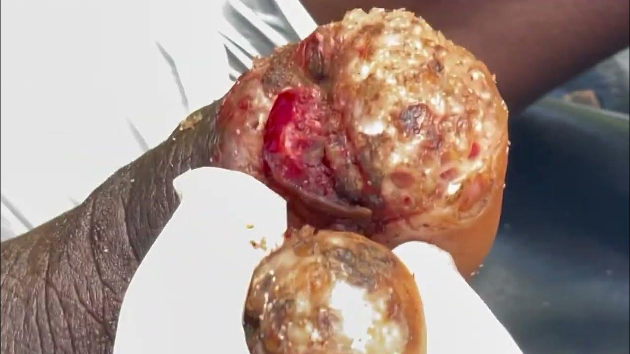 Jigger digging James Nyawidi this man was so jiggered YouTube