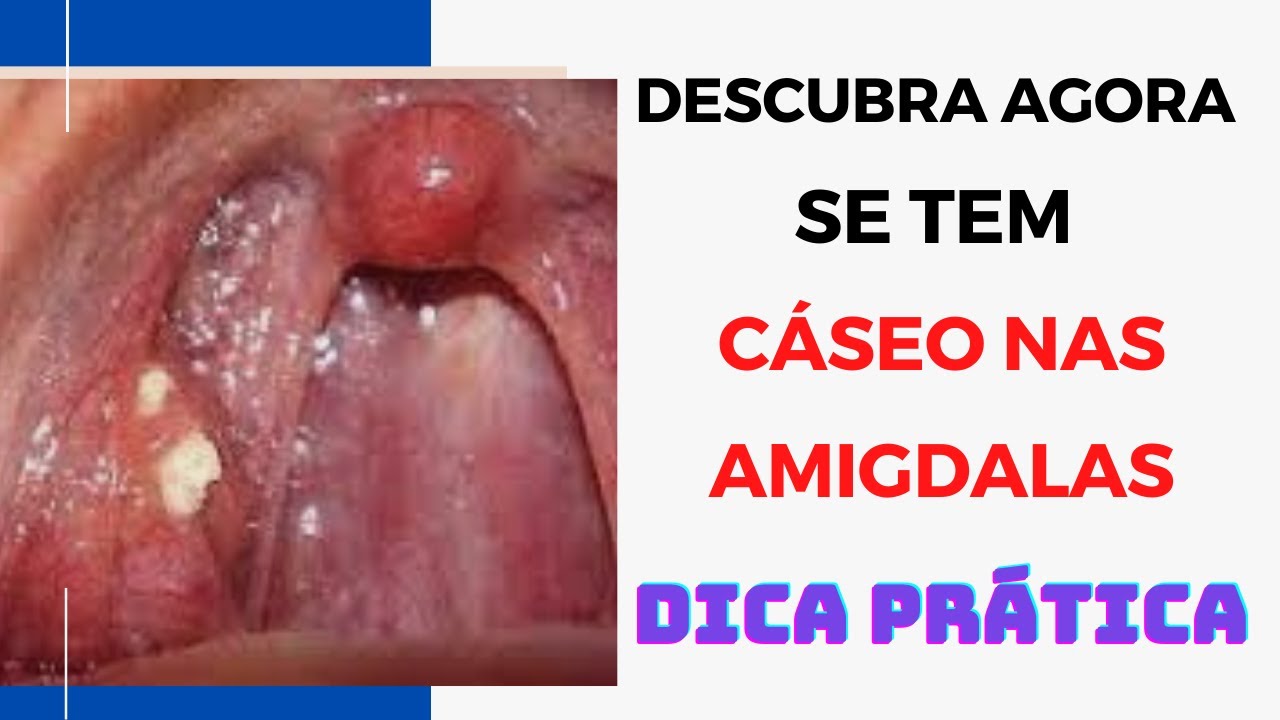 Pedras nas amígdalas: como aparecem e como removê-las em casa