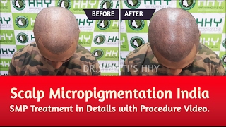 Scalp Micropigmentation India – SMP Treatment in Details with Procedure Video.