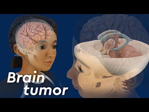 What is Craniopharyngioma?