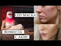 ЧУДО МАСКА ОТ АКНЕ | Стоит ли покупать Impulse Derma Pro маску?