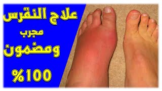 علاج النقرس نهائيا | مرض النقرس اعراضه واسبابه وعلاجه ​بالأعشاب مجرب ومضمون 100%