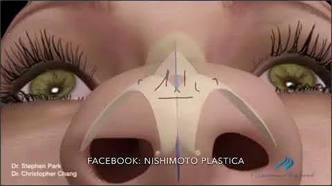Como acabar com o nariz de batata?