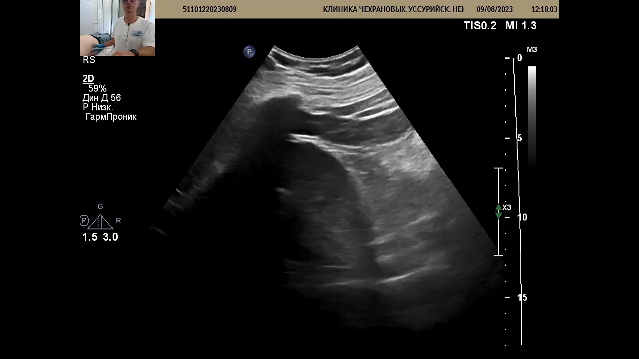 УЗИ почек при почечной колике. Уретерогидронефроз, нефролитиаз.