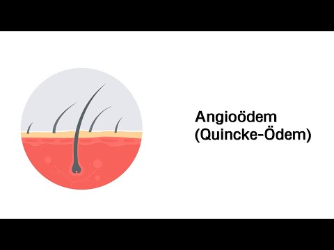 Video: Quincke-Ödem - Ursachen, Symptome Und Behandlung Des Quincke-Ödems. Erste Hilfe