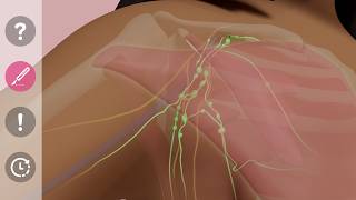 Introduction to Axillary Lymph Node Dissection for Breast Cancer | ALND | Patient Education