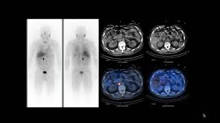 SPECT/CT - II
