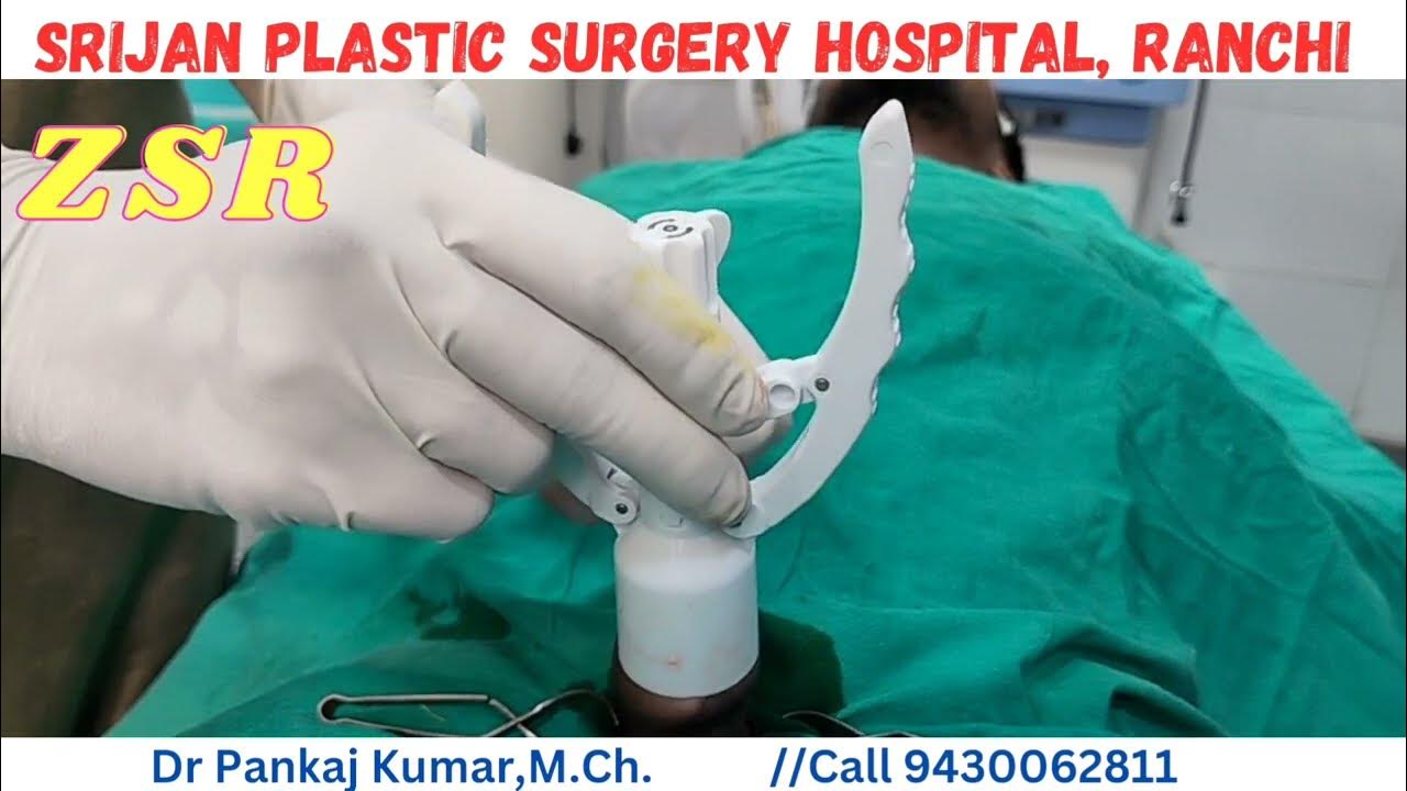 ZSR Circumcision Stapler Circumcision ZSR Circumcision in Ranchi