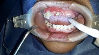 Como se hace una limpieza dental