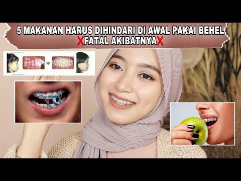 Video: Cara Bersedia untuk Hari Yang Anda Dapatkan Kawat Gigi: 13 Langkah