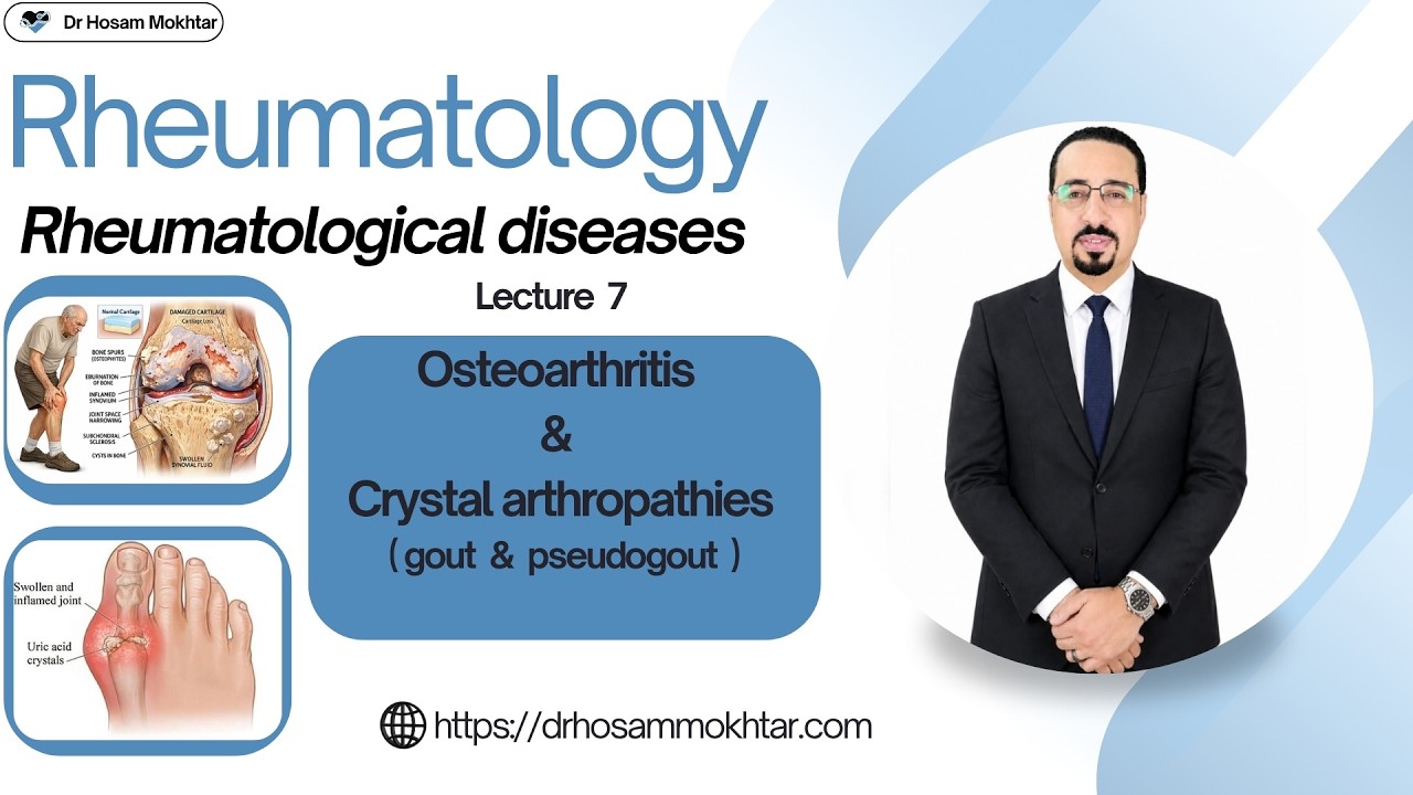 Rheumatology - Lecture 7 - Osteoarthritis & Crystal arthropathies ( Gout & Pseudogout )