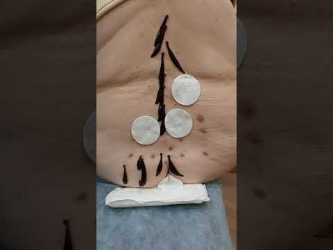 Лечение пиявками часто