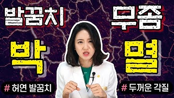 당신의 허연 발꿈치는 각질이 아니라 무좀입니다!ㅣ발바닥에 쓰기 편한 터비뉴겔 무좀약ㅣ무좀 없애는 법