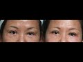 Repairing botched lower eyelid surgery beverly hills plastic surgeon dr kenneth steinsapir