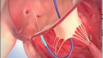 Mitralign Tricuspid Procedure