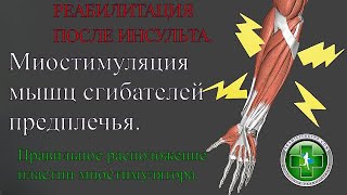 Реабилитация после инсульта. Миостимуляция, сгибатели кисти и пальцев. Расположение электродов.