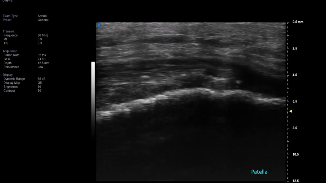 sonosite m turbo usado UHF 48 MHz - Patellar Tendon