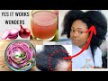 3 best Ways To Use  RED ONION for FASTER  Hair Growth and Thickening. The only video you need sis